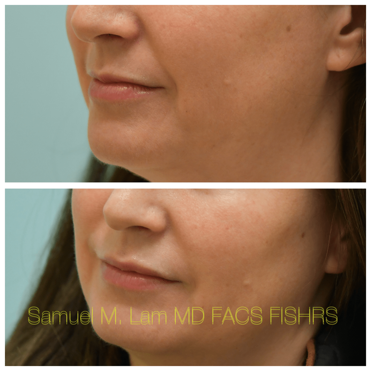 Lip Filler Before and After Photo by Dr. Lam in Plano, TX