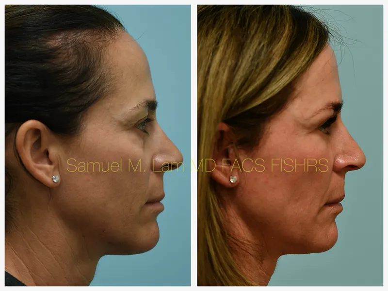 Eyelid Blepharoplasty Before and After Photo by Dr. Lam in Plano TX