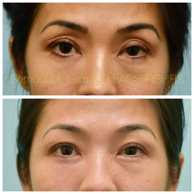 Bilateral ptosis Before and After Photo by Dr. Lam in Plano TX