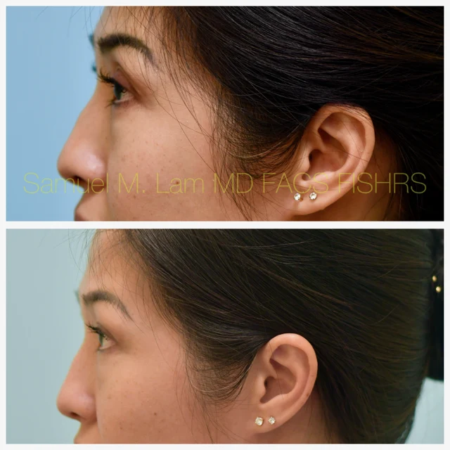 Bilateral ptosis Before and After Photo by Dr. Lam in Plano TX