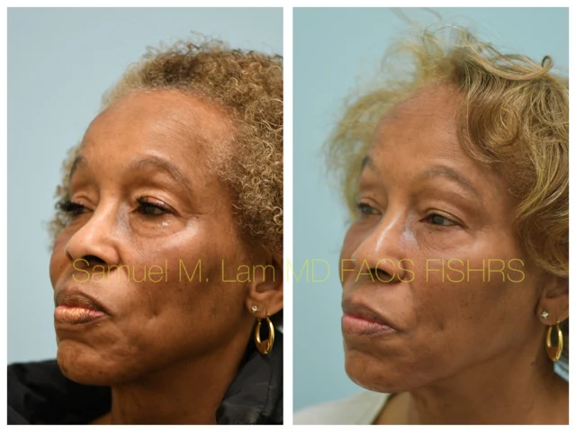 Blepharoplasty and Fat Grafting Before and After Photo by Dr. Lam in Plano TX