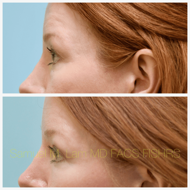 Fat Grafting and Blepharoplasty Before and After Photo by Dr. Lam in Plano, TX