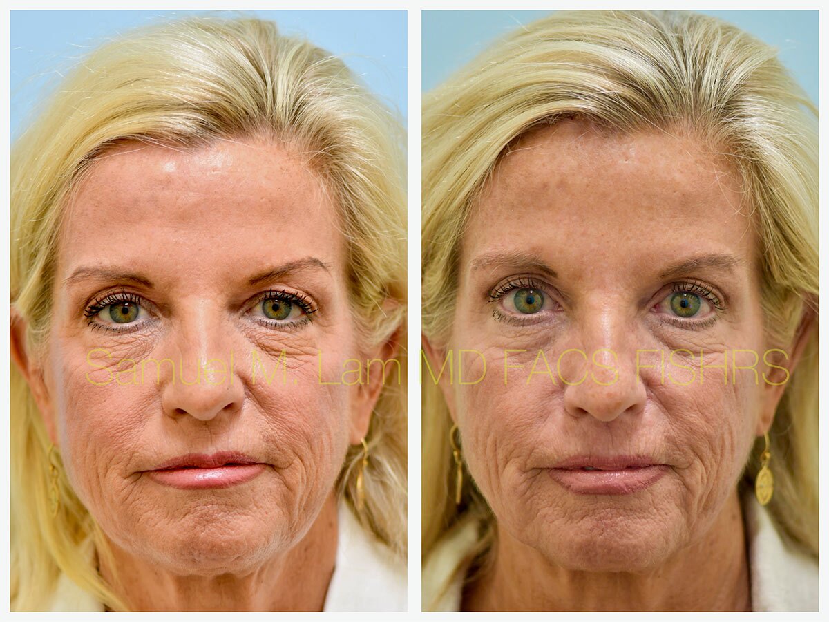 Osteoma Removal Before and After Photo by Dr. Lam in Plano, TX