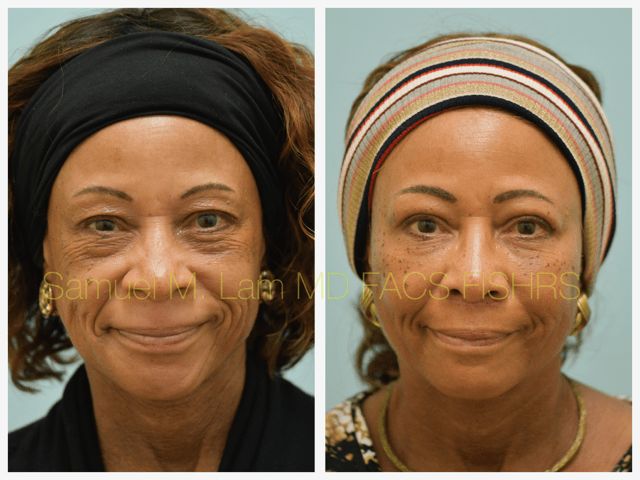 Blepharoplasty, fat grafting, fillers, MesoBotox, lip lift Before and After Photo by Dr. Lam in Plano, TX