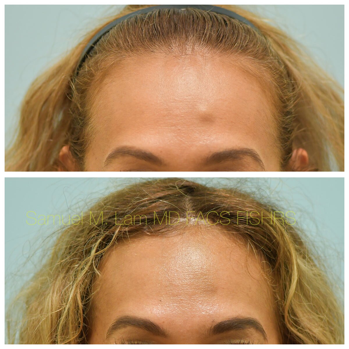 Osteoma Remval Before and After Photo by Dr. Lam in Plano, TX
