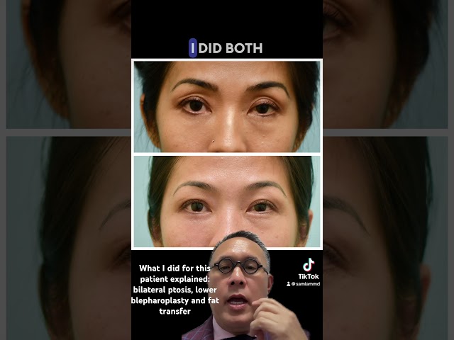 What I did for this patient explained: bilateral ptosis, lower blepharoplasty and fat transfer