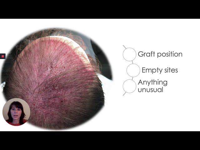 Dallas Hair Transplant Coordinator Emina Vance Lectures on Critical Thinking at the End of the Case