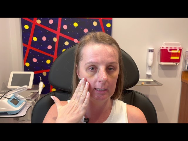 Dallas Rhinoplasty/Nose Job Testimonial One Week Out