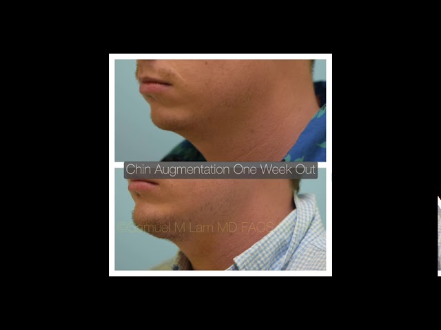 Dallas Chin Augmentation Testimonial One Week Out