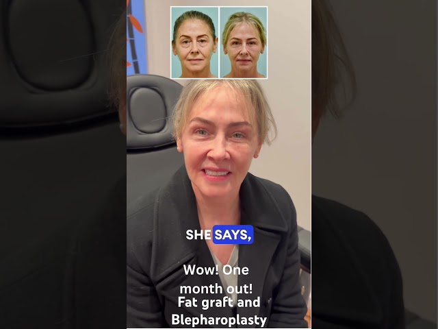 One month out from Fat graft and Blepharoplasty