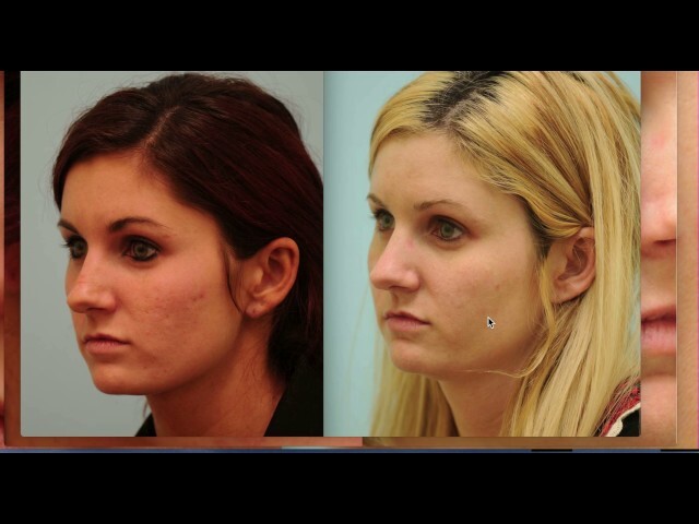 Acne Scarring Silicone Micro Before & After with Video Narration