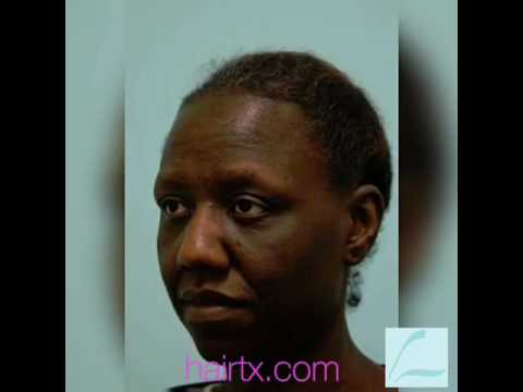 Eyebrow Hair Transplant Videos/Testimonials