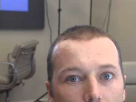 Scar Revision Geometric Broken Line Repair Testimonial