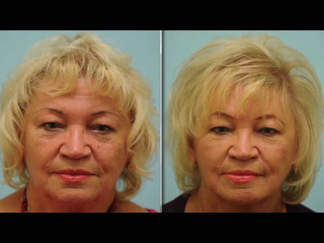Injectable Filler Testimonial (in Russian)