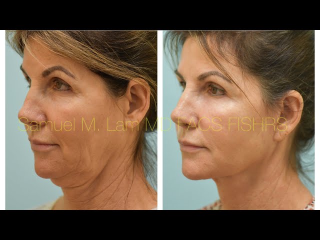 Deep-Plane Facelift, Deep Neck Lift, and Fat Transfer in Dallas, Texas with Dr. Lam 7 Months Out