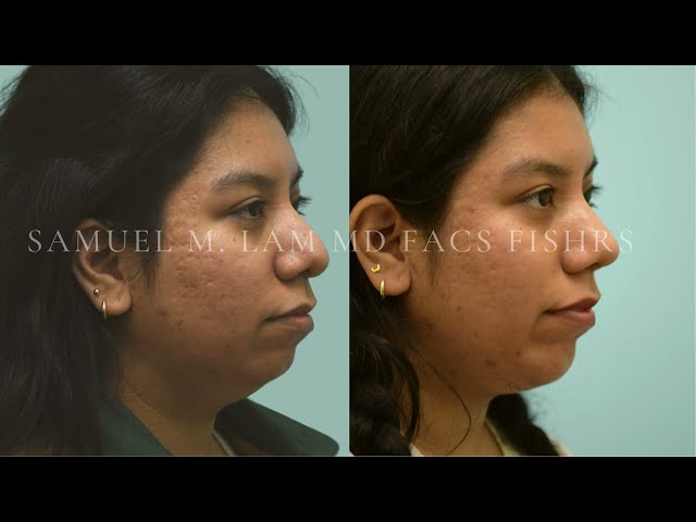 Dallas Cosmetic Surgery | Rhinoplasty & Chin Implant | Patient Testimonial