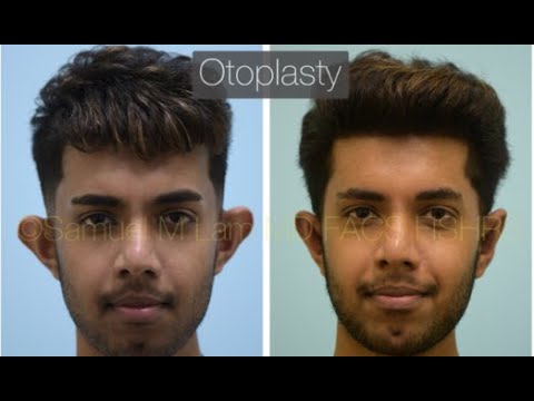 Dallas Otoplasty Before & After