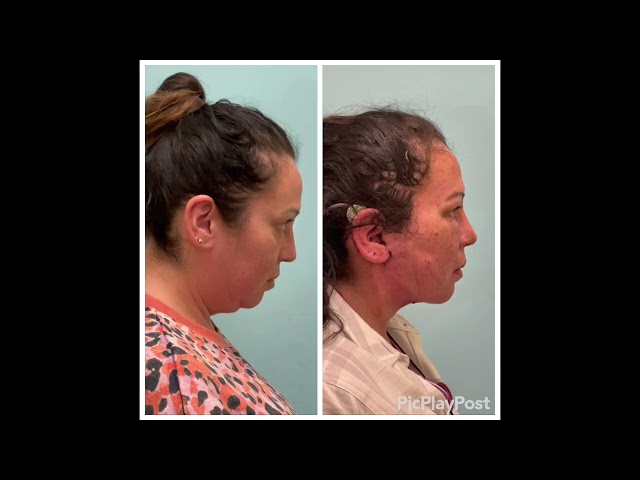 Deep Neck & Facelift One Day Out