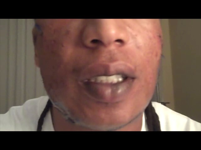 Keloid Recovery Video Following Surgery & Radiation in Dallas, Texas