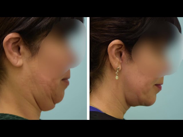 Dallas Facelift Audio Testimonial with Photos