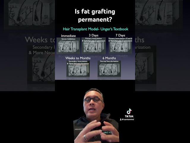 Is fat grafting permanent?