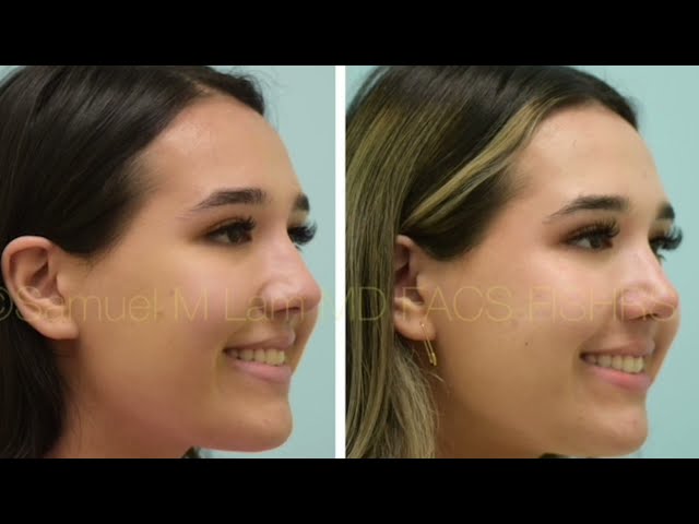 Dallas Rhinoplasty/Nose Job Before and After