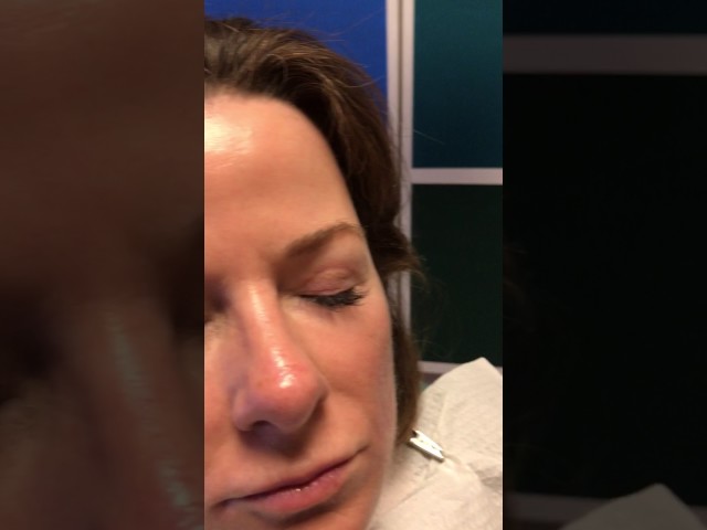 Dallas Facelift, Rhinoplasty, Blepharoplasty Incisions Close-Up