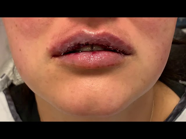 Dallas Silicone Lip Reduction/Correction