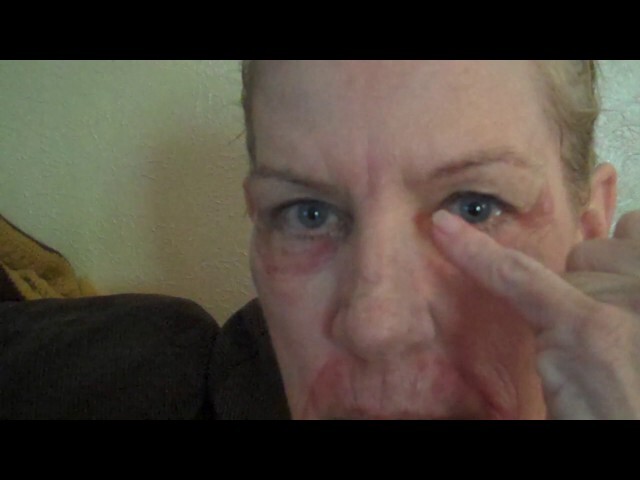 Dallas Sciton Laser Recovery Video with Half Face Coverage using Oxygenetix