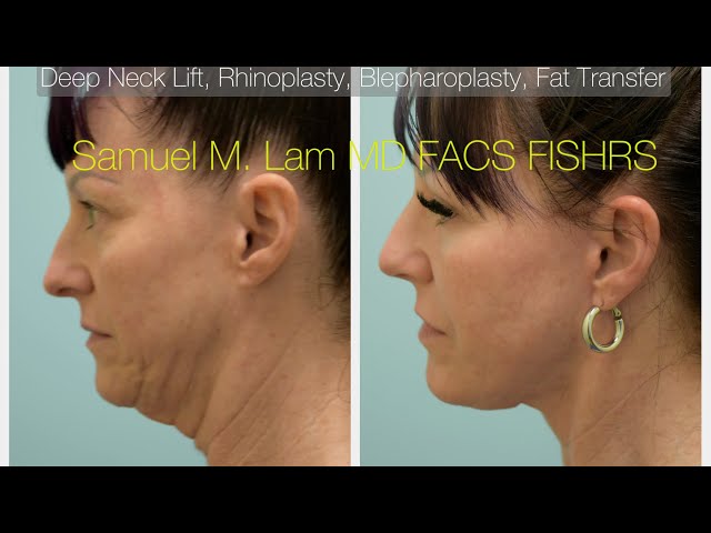 Deep Neck Lift, Deep Plane Facelift, Rhinoplasty, Upper/Lower Blepharoplasty, Fat Graft Testimonial