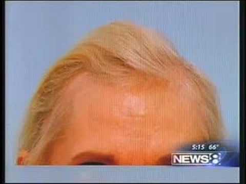 FEMALE HAIR TRANSPLANT AND HAIR LOSS NEWS SEGMENT
