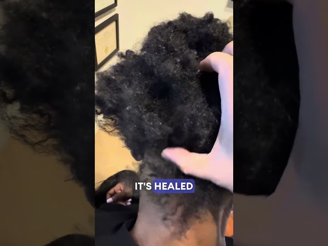 Do keloids prevent me from doing a hair transplant?