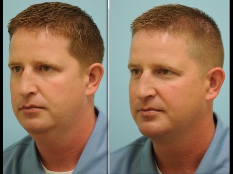 Liposuction/Lipocontouring Testimonials