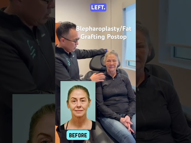 Blepharoplasty/Fat Grafting Postop One Week