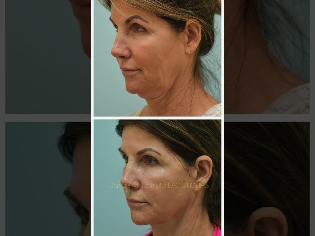 One year after deep neck lift, dee-plane facelift, full-facial fat grafting w/photos & testimonial