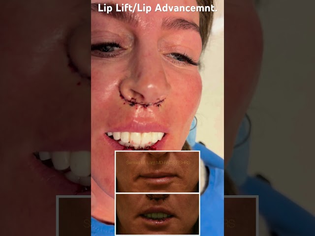 Lip Lift/Lip Advancement Immediately After Procedure in Dallas, Texas