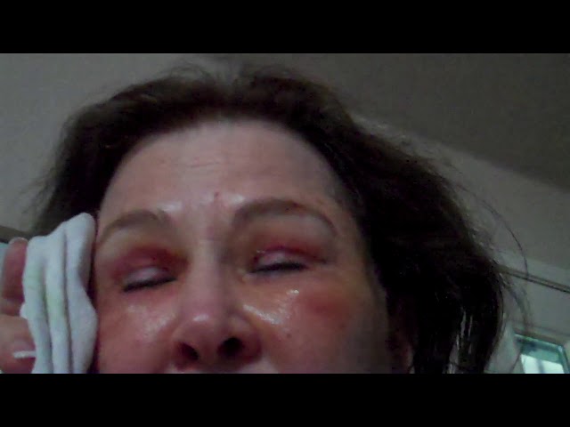 Dallas Facelift/Fat Transfer/Upper & Lower Eyelid Blepharoplasty/Eyelid Laser Recovery Video