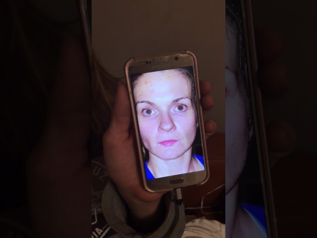 Botox and Fillers for a Patient who drove 10 hours