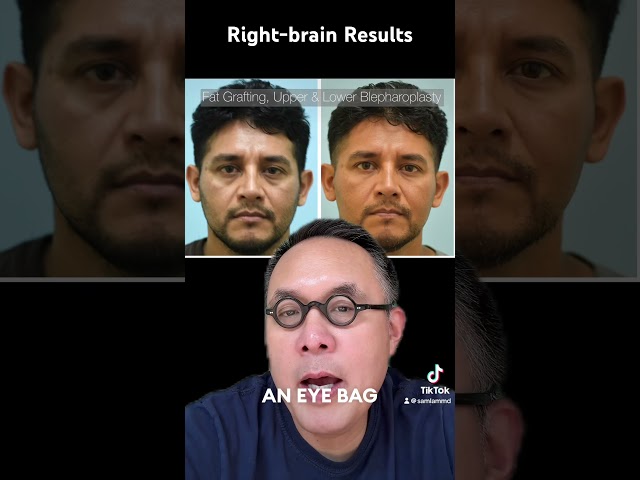 Right-brain Results with Fat Grafting:  What’s the Goal of a Fat Transfer to the Face