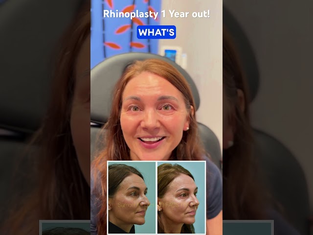 Rhinoplasty 1 Year out! #dallasrhino #dallasrhinoplasty #dallasnosejob #nosejobdallas