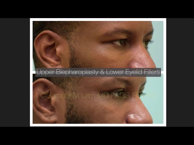 Dallas Upper Blepharoplasty and Lower Eyelid Testimonial (Audio) with Photos