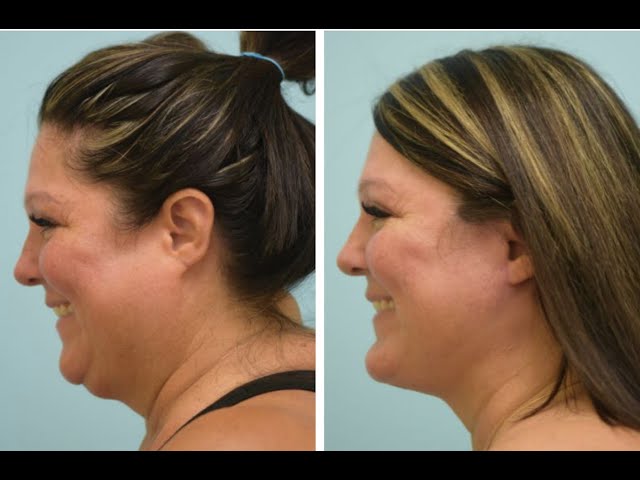 Deep-Plane Facelift & Extended Anatomic Chin Implant Testimonial