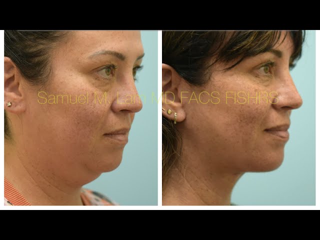 Life-Changing Deep Neck Lift & Deep-Plane Facelift Testimonial with Photos