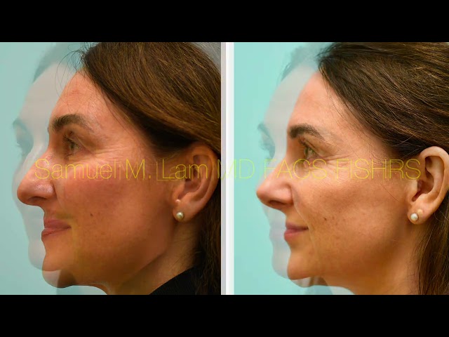 Rhinoplasty 3 Months Out in Dallas, Texas with Dr. Sam Lam