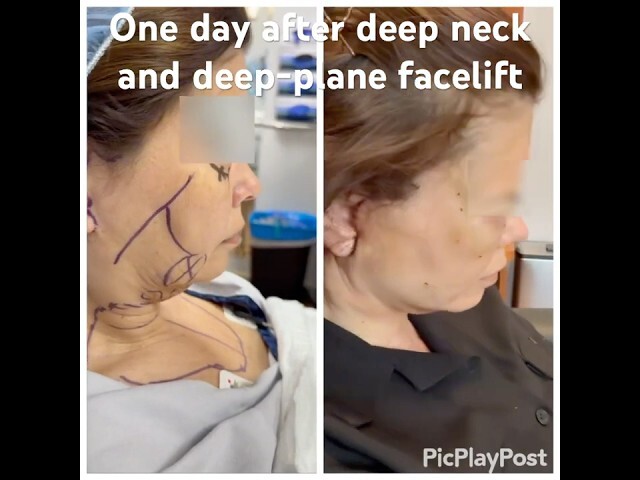 One day after deep neck and deep-plane facelift
