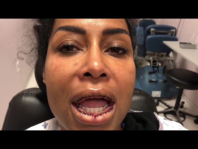 Dallas Lip Correction/Reduction Immediately After