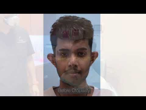 Dallas Otoplasty Postop One Day After