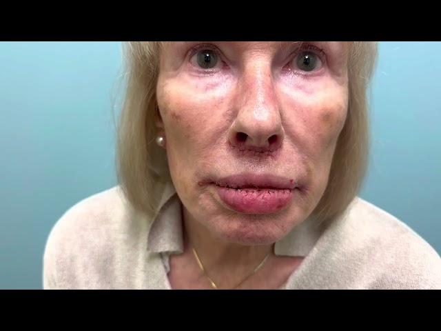 Lip Lift, Corner of the Lip Lift, Lip Advancement, Lip Reduction Testimonial One Week with Photos