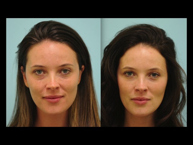 Amy's Cosmetic Eyelid Fillers Testimonials in Dallas, TX