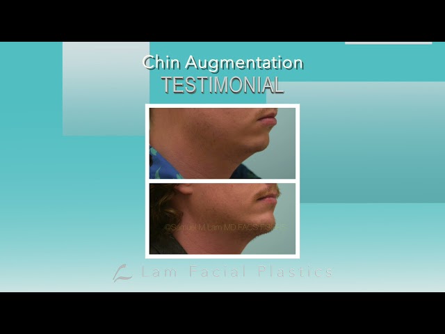 Dallas Chin Augmentation Audio Testimonial with Photos